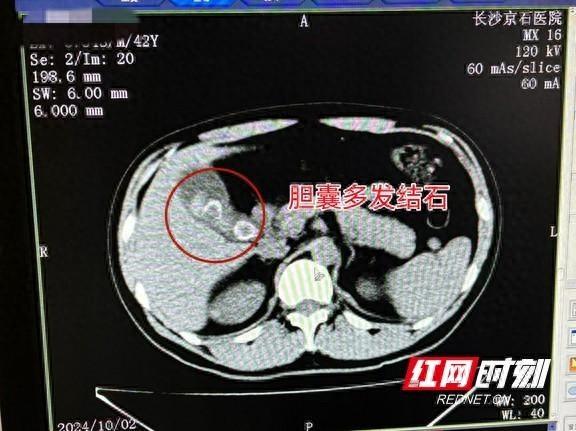 男子腹部持续绞痛，竟以为是胃痛！真相令人