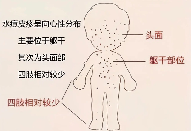 初中生频发水痘，家长困惑：是抵抗力下降还是病毒变异？专家解读背后真相  第2张