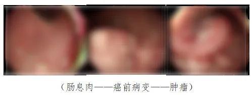29 岁男子确诊肠癌晚期，家族遗传竟成夺命杀手  第2张