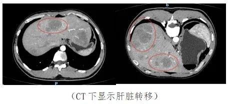 29 岁男子确诊肠癌晚期，家族遗传竟成夺命杀手  第3张