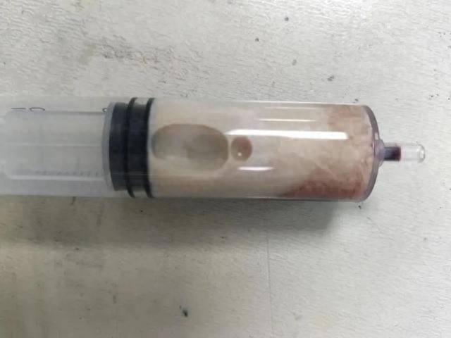 连吃一周汉堡和猪脚饭，两个小伙子竟抽出牛奶血！高脂性胰腺炎惊现福建医院