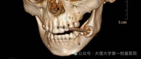 2岁幼儿误吞电池爆炸，口腔内惊现黑色粉末！家长必知的儿童安全警示