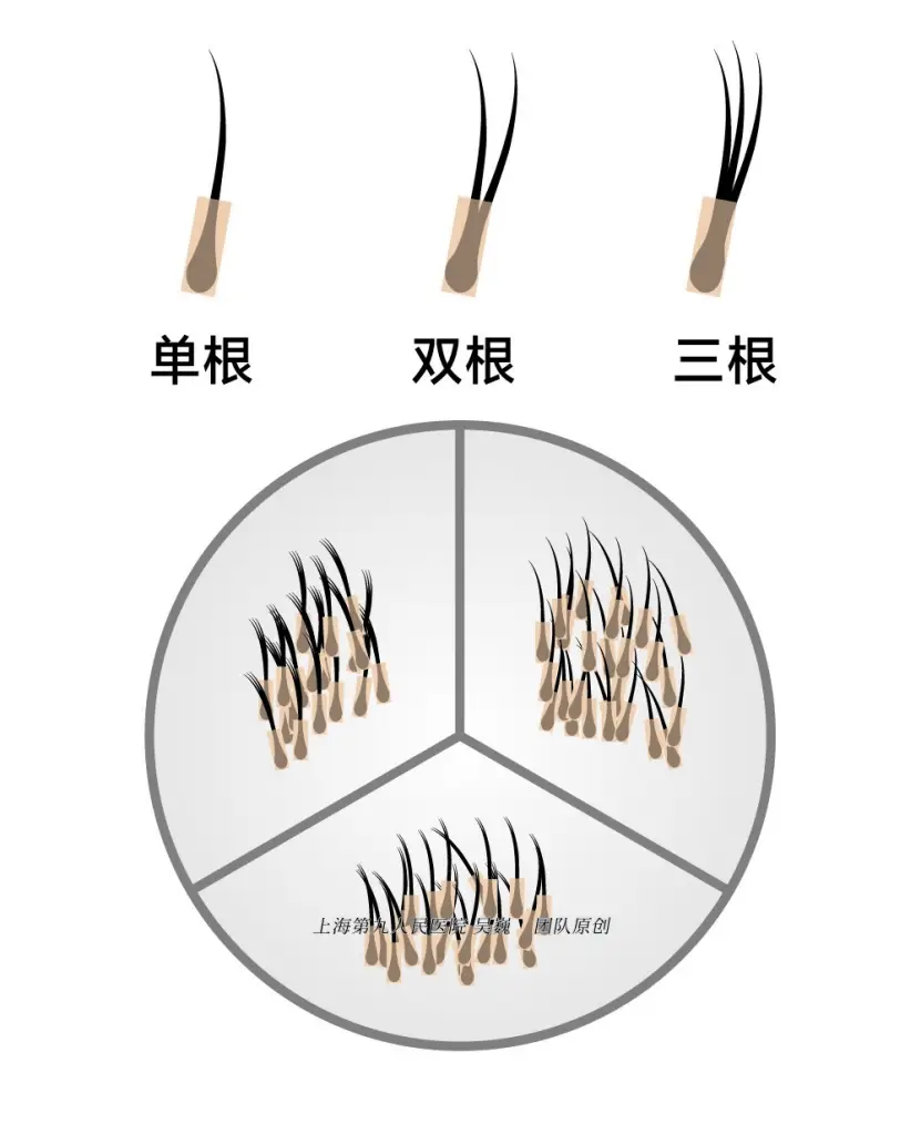 植发术大揭秘！让你告别脱发困扰，重焕自信  第2张