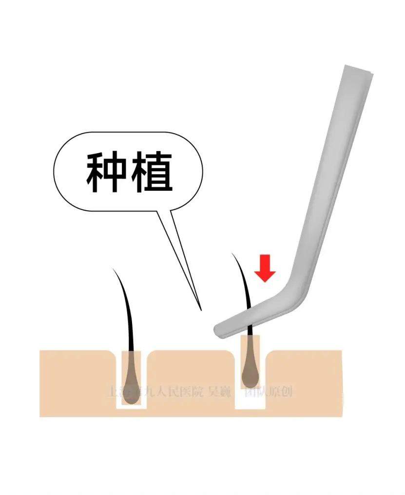 植发术大揭秘！让你告别脱发困扰，重焕自信  第3张