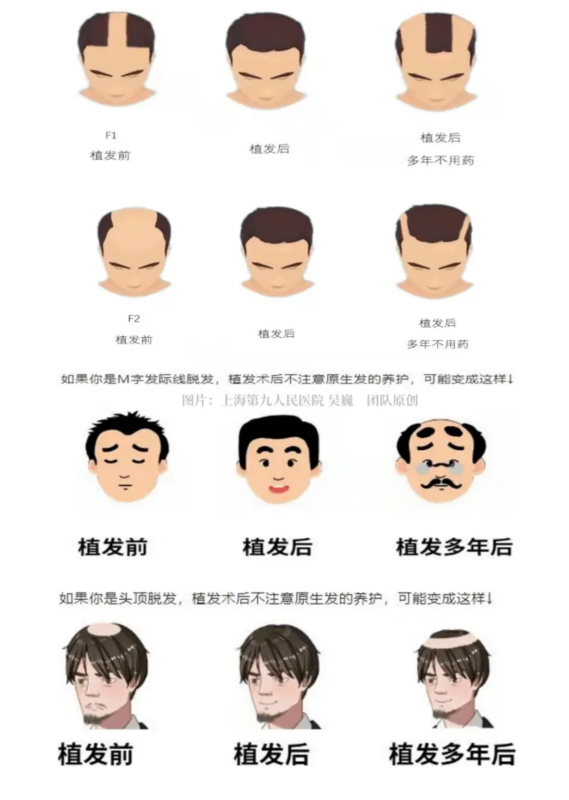 植发术大揭秘！让你告别脱发困扰，重焕自信  第5张