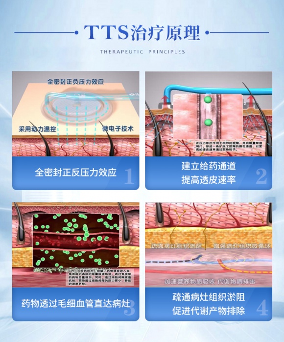 成都中医哮喘医院：动力温控经皮给药技术，肺结节治疗的革命性突破  第2张