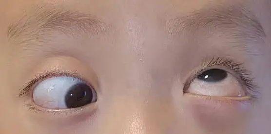 罕见！先天性多眼外肌缺失，患儿多年视物困扰终解除