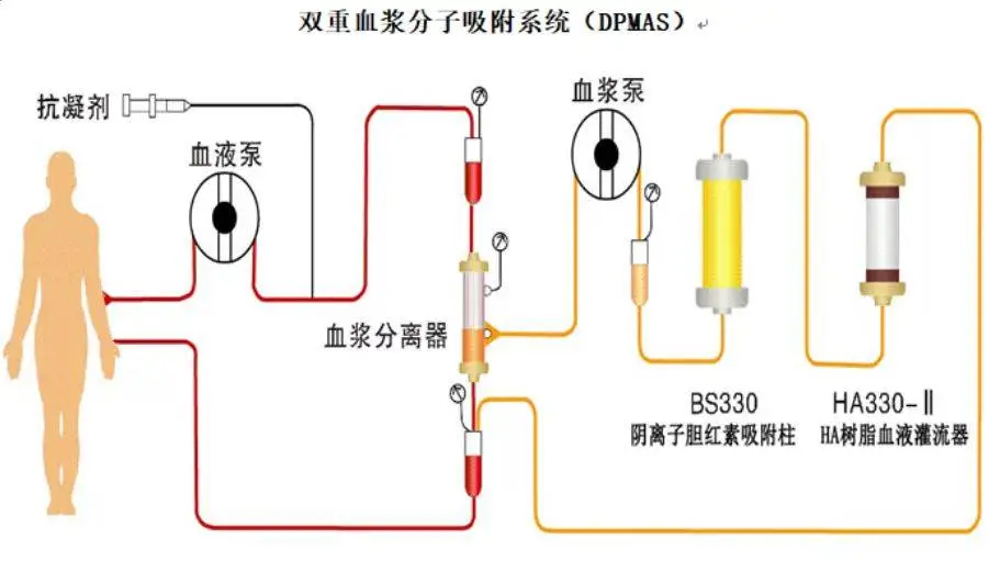59 岁女子肝功能衰竭命悬一线，人工肝能否成为救命稻草？  第2张