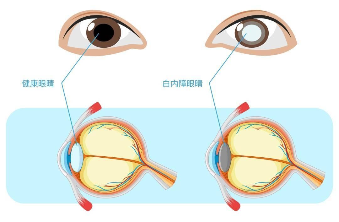 白内障为何盯上年轻人?央视财经中国好医生为你揭秘 第6张 白内障为何盯上年轻人?央视财经中国好医生为你揭秘 第6张