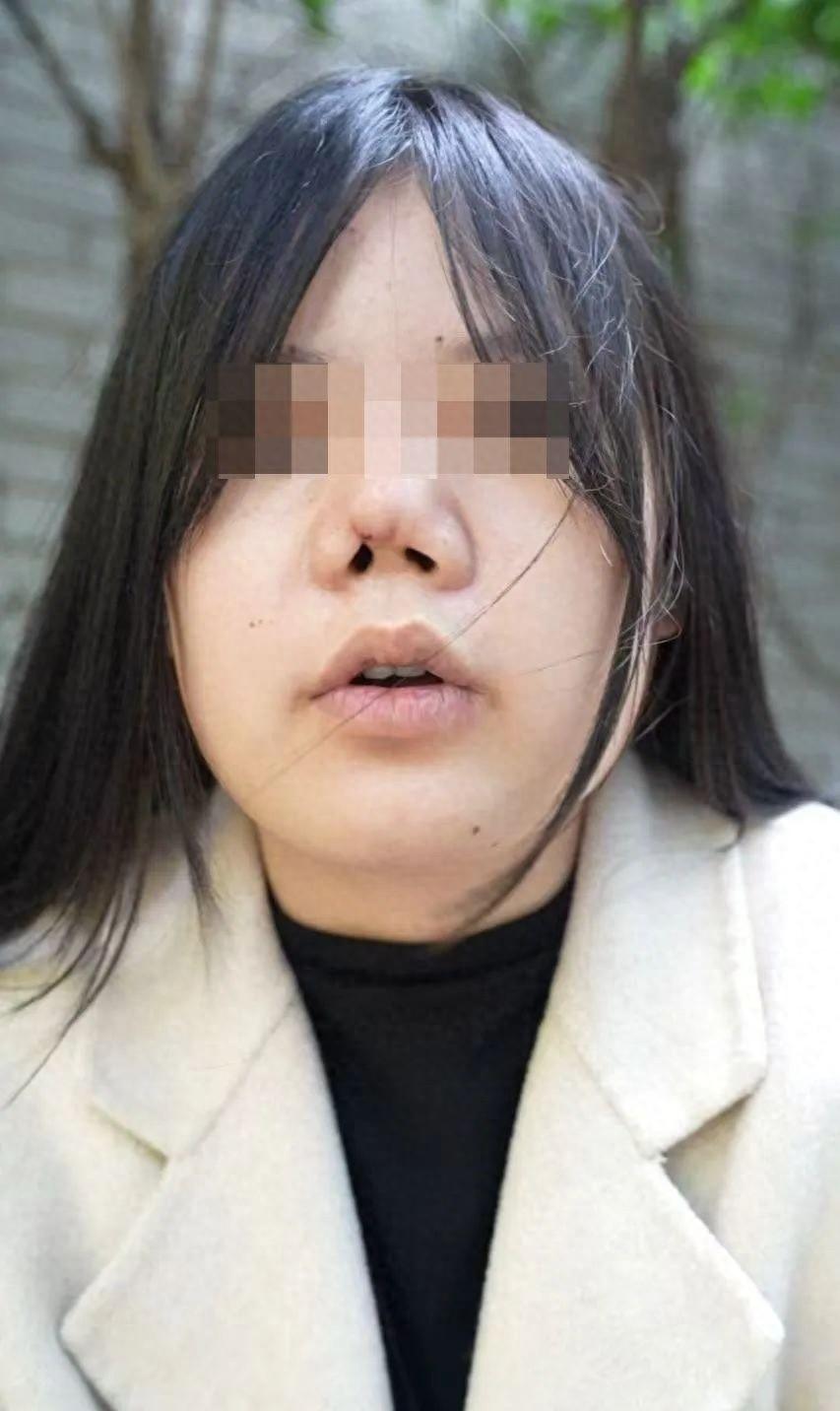 贷款 4 万做肋骨鼻，术后竟成猪鼻子！女子维权遭医院敷衍，现已重度抑郁