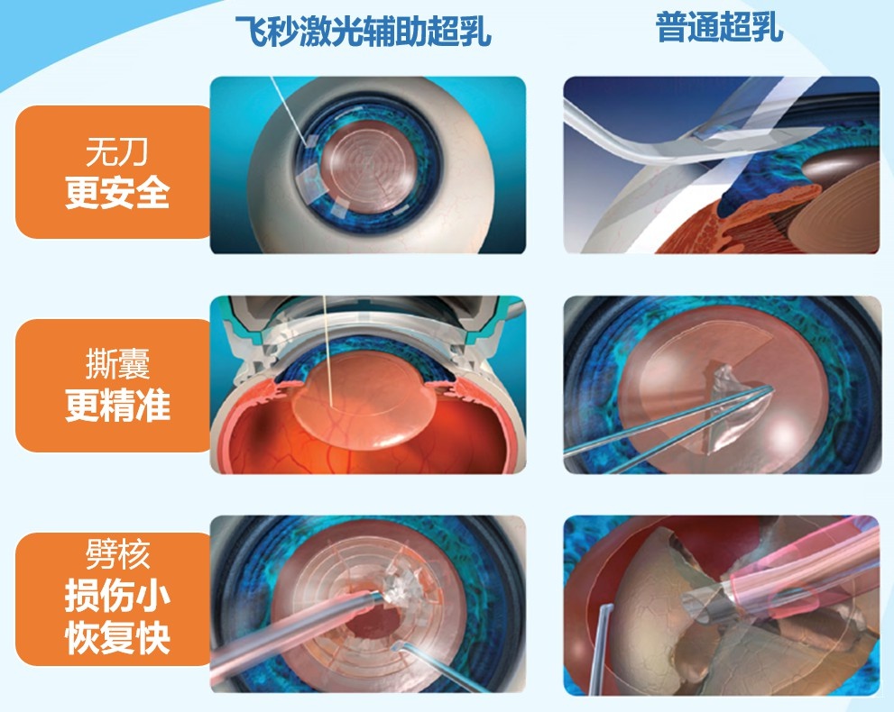 飞秒白内障手术VS普通手术：科技进步如何重塑光明未来？  第2张