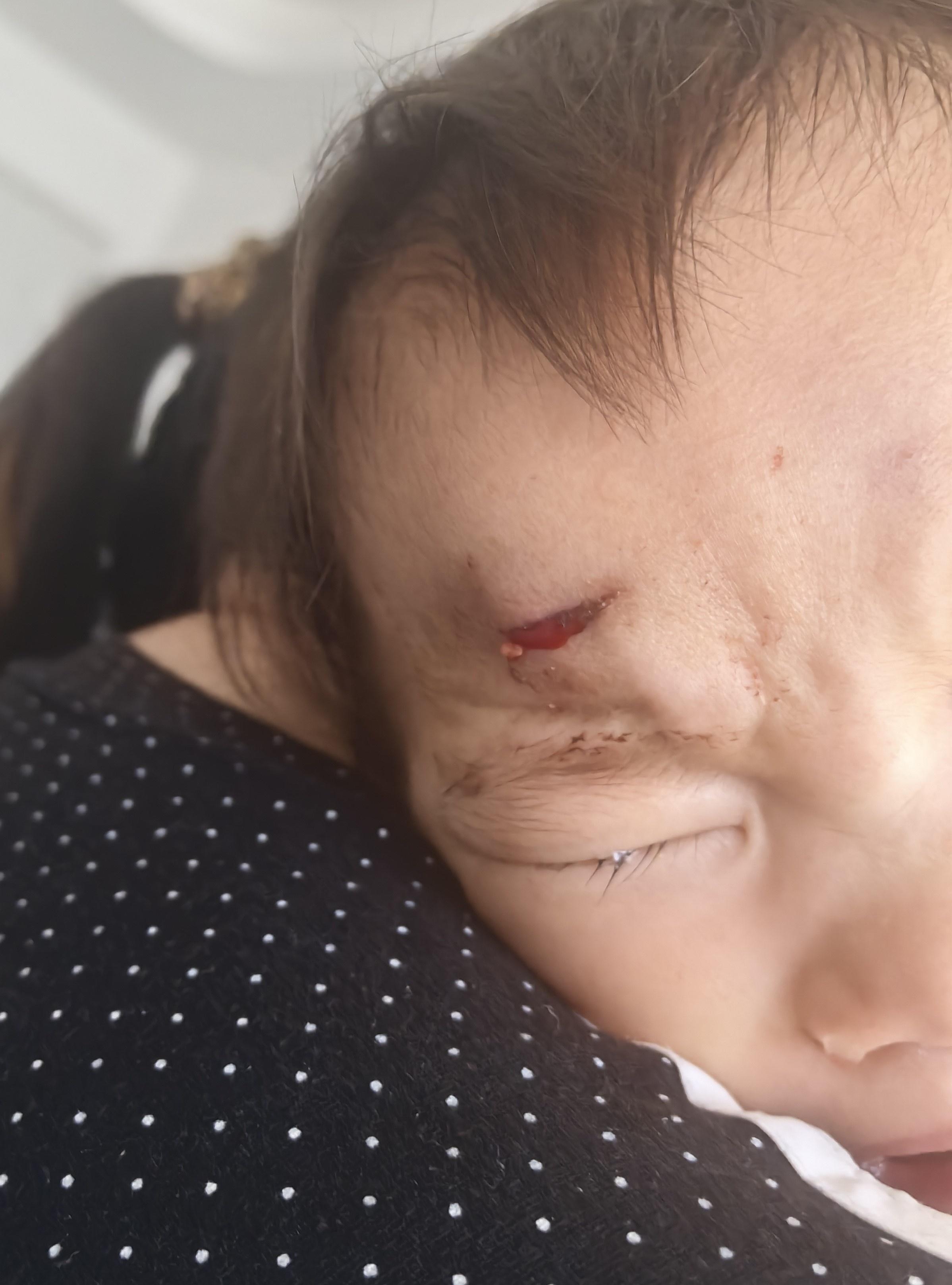 1 岁 8 个月女童在月儿湾国际亲子游泳俱乐部受伤，后续治疗情况如何？  第2张