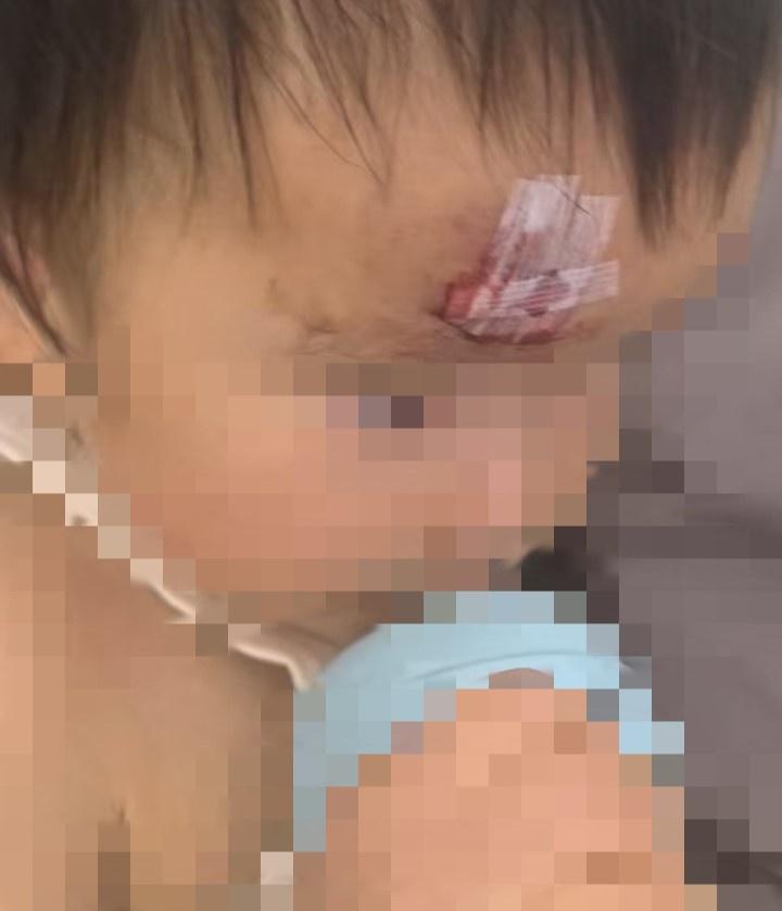 1 岁 8 个月女童在月儿湾国际亲子游泳俱乐部受伤，后续治疗情况如何？  第3张