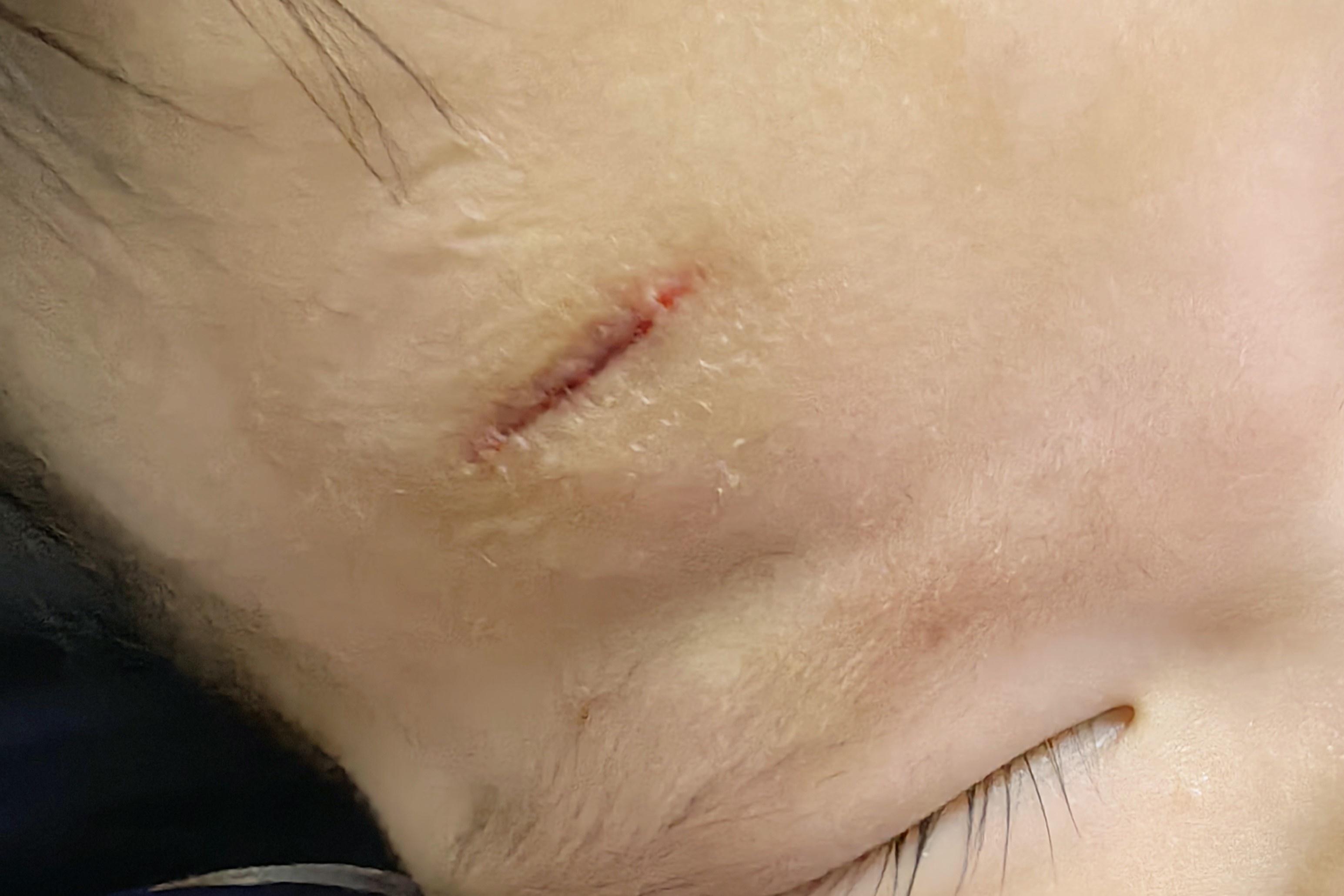 1 岁 8 个月女童在月儿湾国际亲子游泳俱乐部受伤，后续治疗情况如何？  第5张