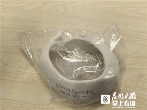 3D打印+生物材料：一场车祸后的奇迹重生，母亲从昏迷到重塑完整人生  第2张