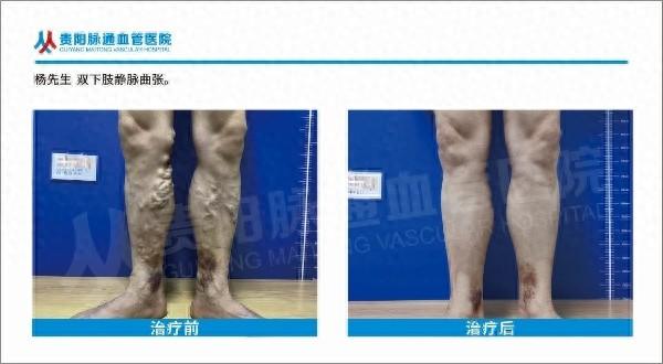 65 岁退休教师饱受静脉曲张折磨，贵阳脉通血管医院成功施救  第1张
