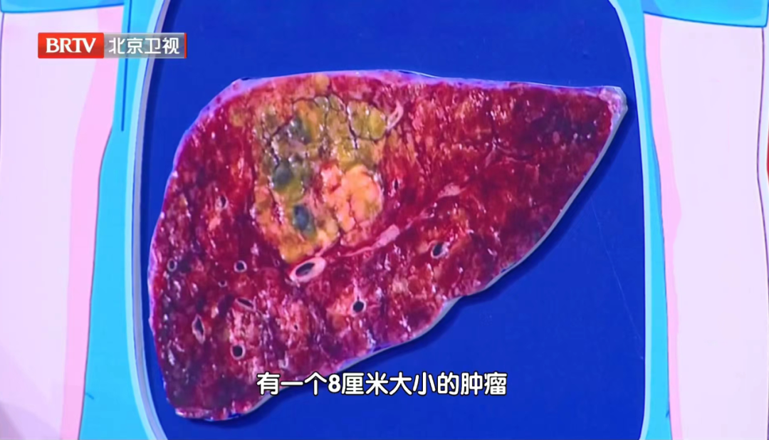 别把腹泻不当回事，肝癌可能已悄悄埋伏在身边  第3张