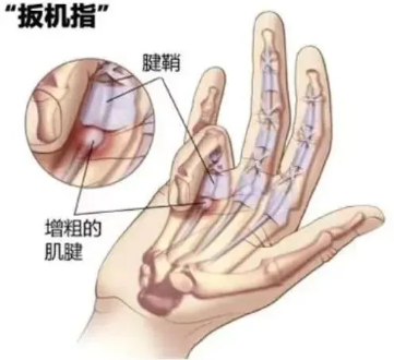 经常掰手指会得关节炎？真相竟然是这样  第2张