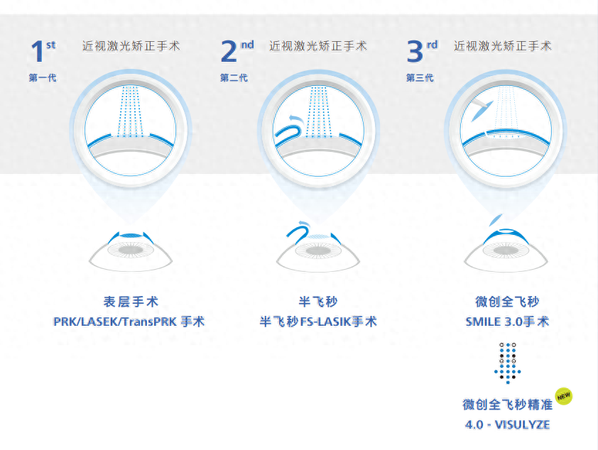 近视患者看过来！全飞秒 3.0 和精准 4.0，你该怎么选？  第1张