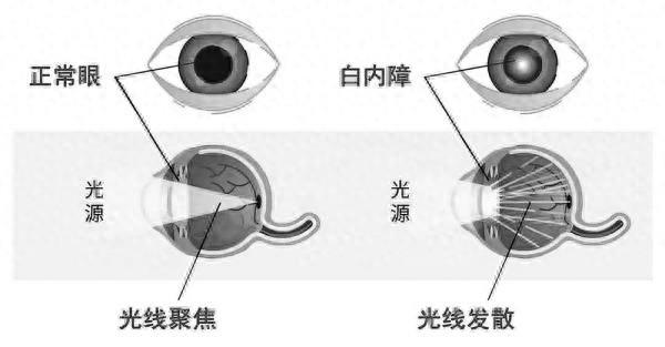12 岁女孩竟患上白内障，这些误区你还在信吗？