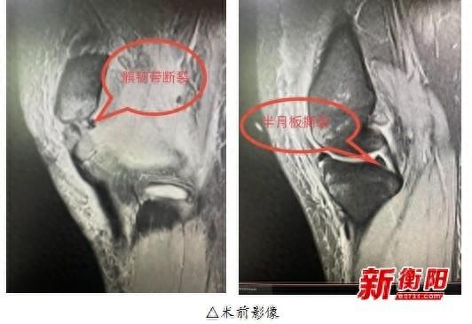 一次手术解决多处损伤！南华医院骨科实力惊人