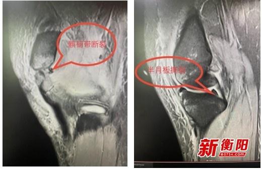 一次手术解决多处损伤！南华医院骨科实力惊人  第2张