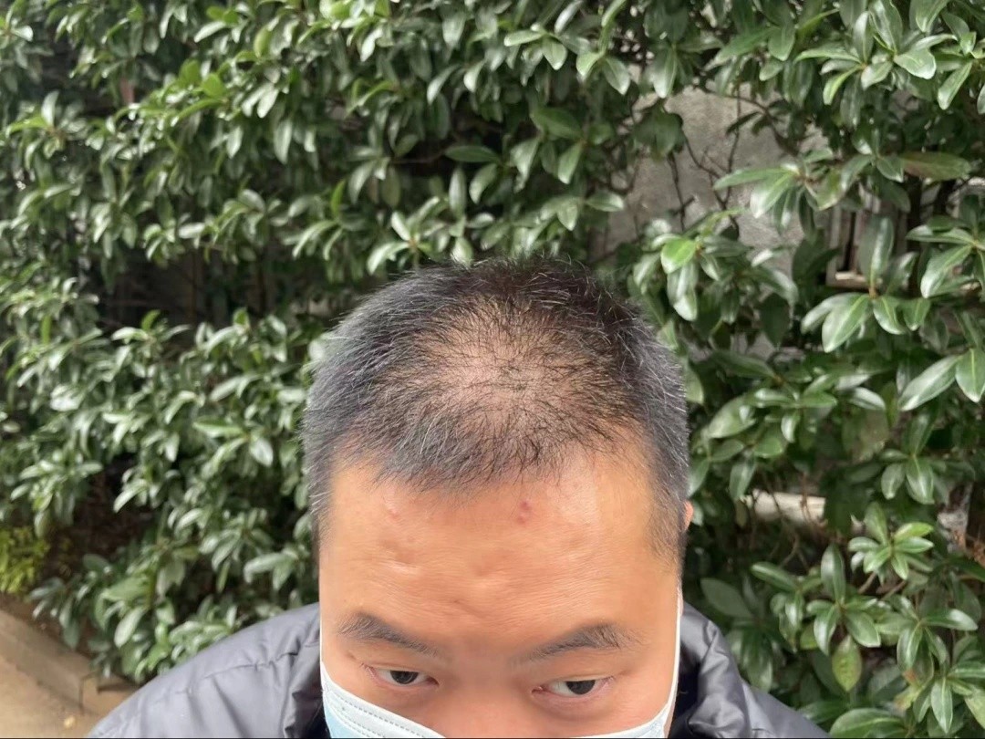 30岁男子花8000多植发9个月后仍无效果，后脑勺像狗啃，要求退一赔三  第1张