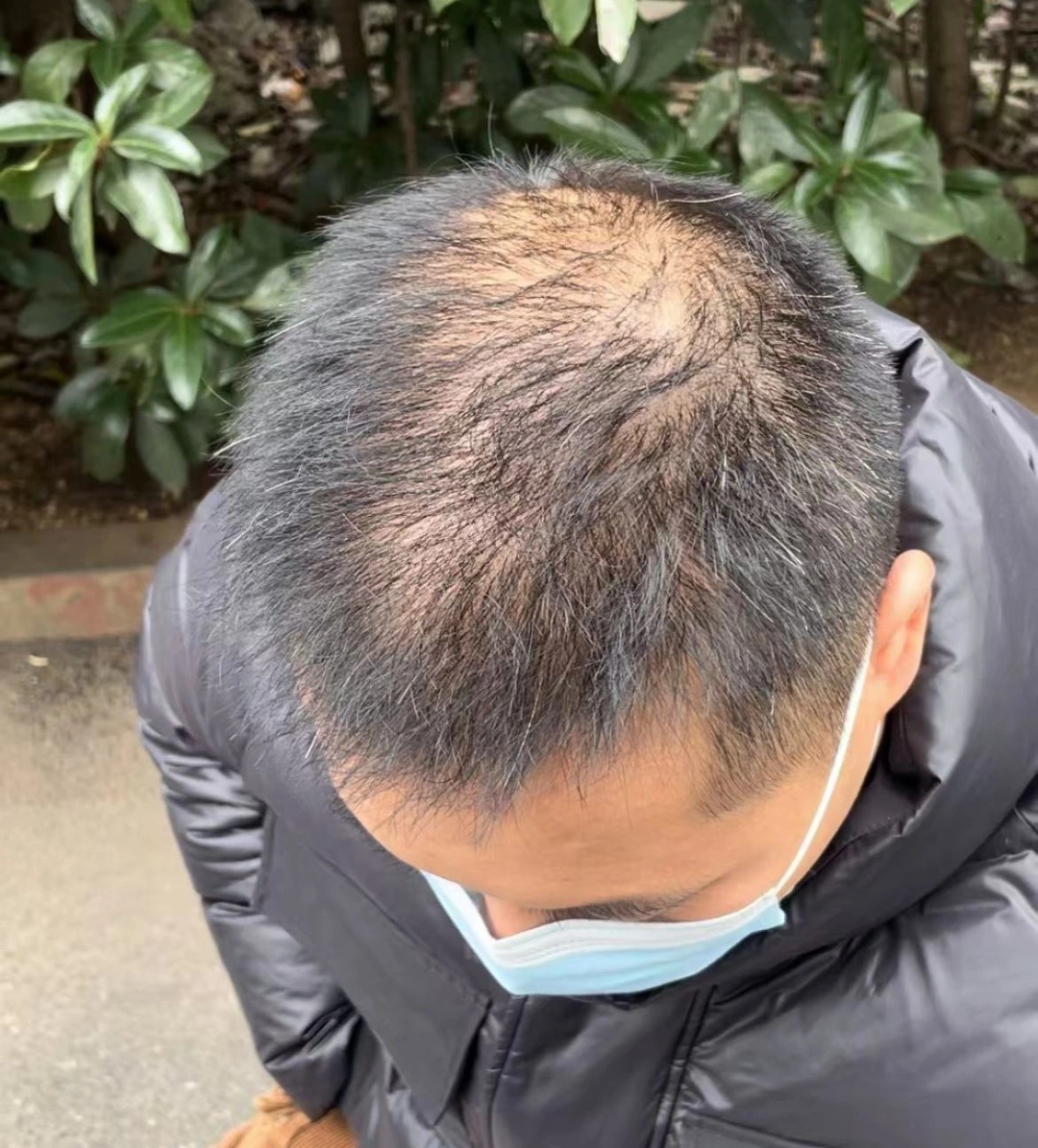 30岁男子花8000多植发9个月后仍无效果，后脑勺像狗啃，要求退一赔三  第3张