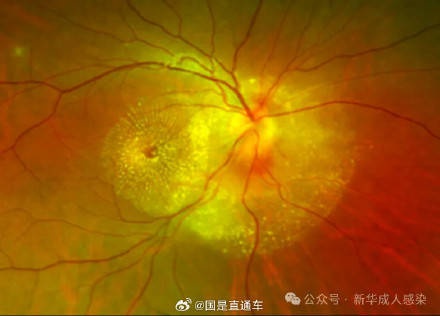 小伙被流浪猫咬伤后视力骤降，真相竟是这种罕见病