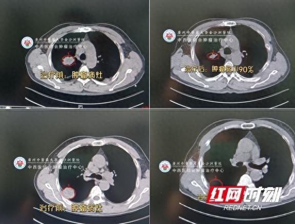 61岁老人咳血不止，竟是肺癌晚期！广州这家医院如何逆转命运？  第1张