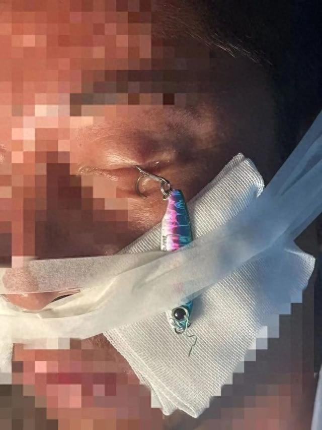 大连男子海钓被鱼钩刺穿左眼，现场惨不忍睹  第1张