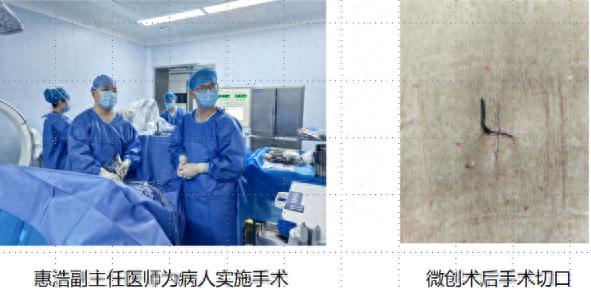 87岁退休教师腰腿痛十余年，椎间孔镜手术后奇迹般恢复正常生活  第1张