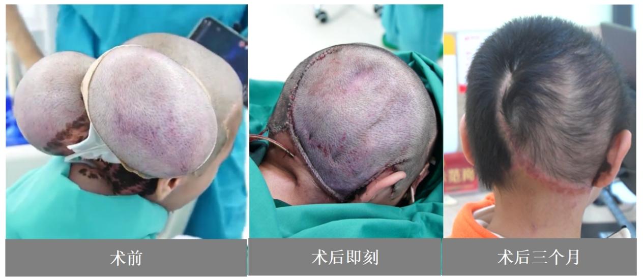 4岁男孩战胜恶魔手掌般的巨痣，迎来人生新篇章  第3张