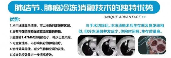 肺结节冷冻消融术：6mm 磨玻璃样结节的克星，让生命重焕生机  第2张