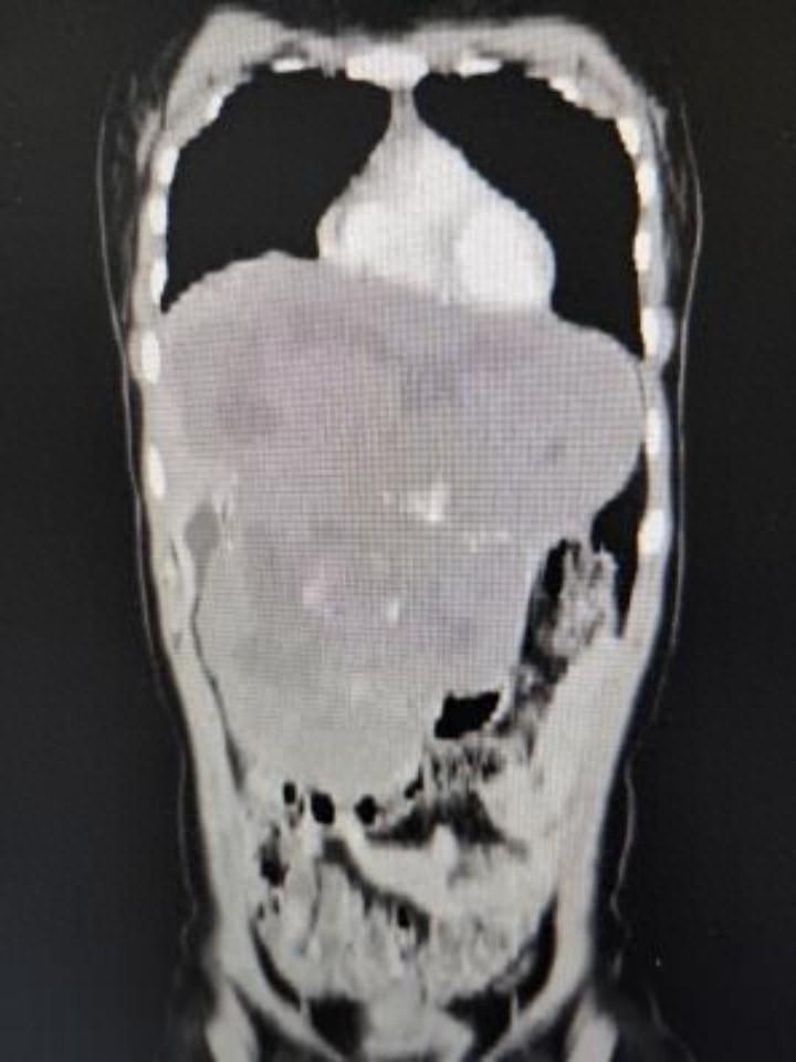 35 岁女子体内惊现超巨大肝血管瘤,直径超 30cm,占满腹腔 第1张 35 岁女子体内惊现超巨大肝血管瘤,直径超 30cm,占满腹腔 第1张