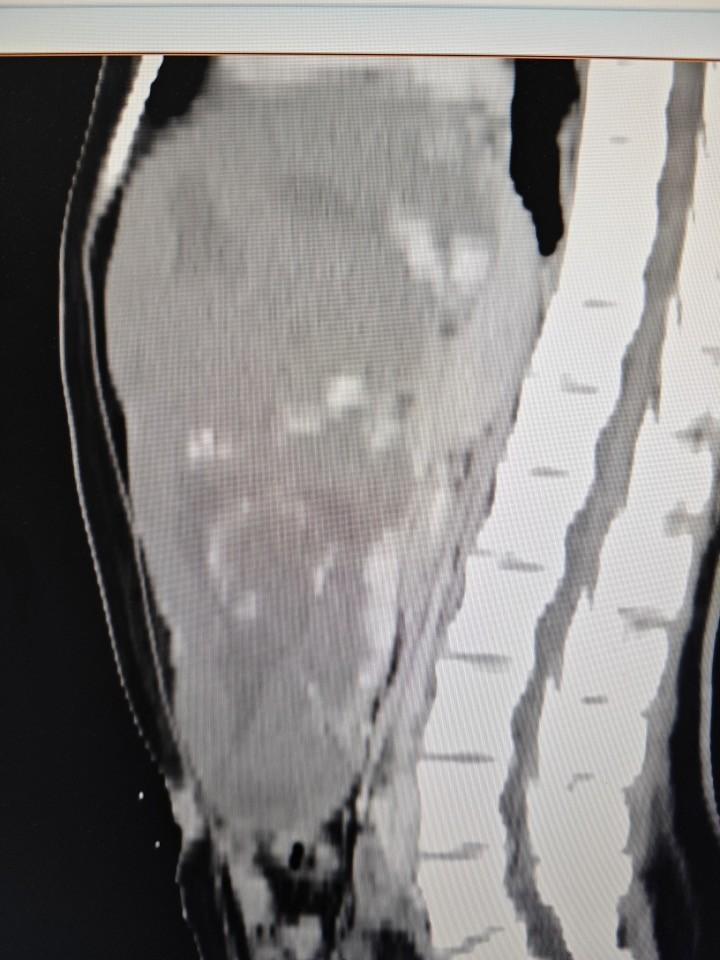 35 岁女子体内惊现超巨大肝血管瘤,直径超 30cm,占满腹腔 第2张 35 岁女子体内惊现超巨大肝血管瘤,直径超 30cm,占满腹腔 第2张