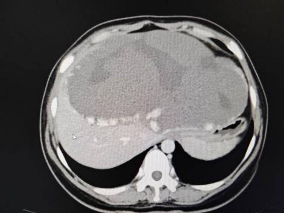 35 岁女子体内惊现超巨大肝血管瘤,直径超 30cm,占满腹腔 第3张 35 岁女子体内惊现超巨大肝血管瘤,直径超 30cm,占满腹腔 第3张