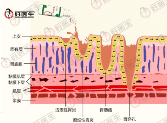 晨起口臭、胃痛不止？可能是幽门螺杆菌在作祟，早发现早治疗  第3张