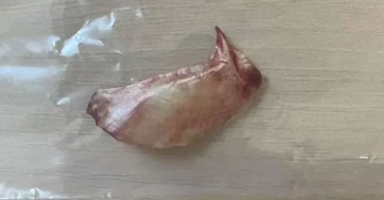 鱼刺卡喉险丧命！老司机的错误自救法，你还在用吗？