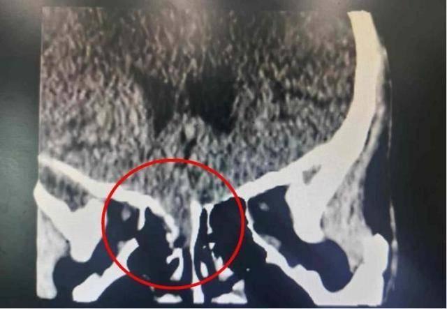 男子流鼻涕 2 个月，原因竟是脑子漏水了  第2张