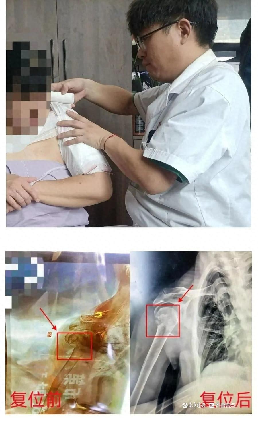 中医正骨手法一次复位成功，三位骨折患者均恢复良好  第1张