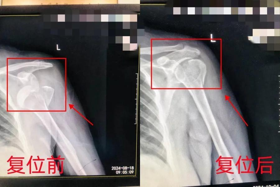 中医正骨手法一次复位成功，三位骨折患者均恢复良好  第2张