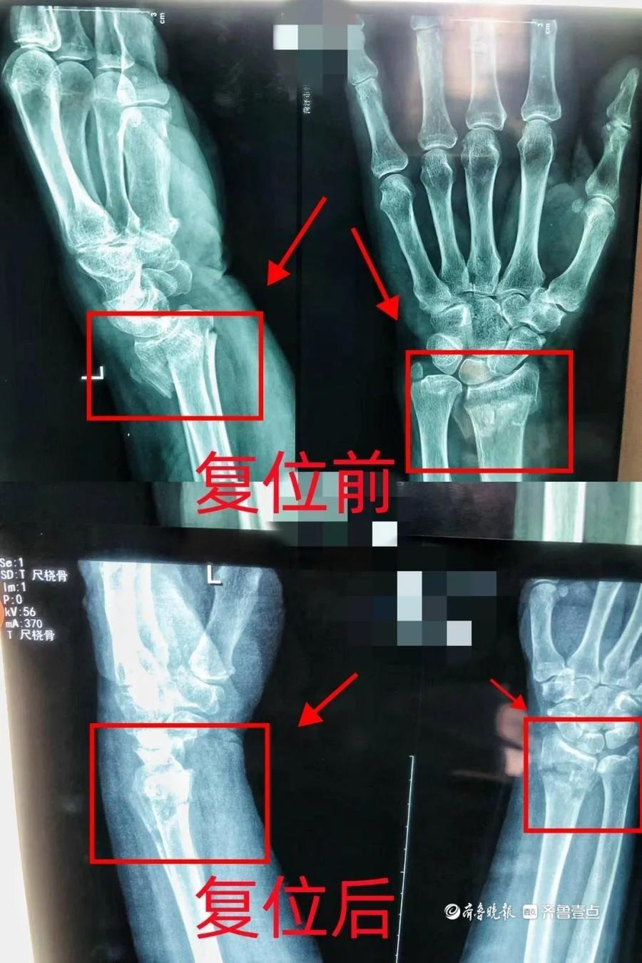 中医正骨手法一次复位成功，三位骨折患者均恢复良好  第3张