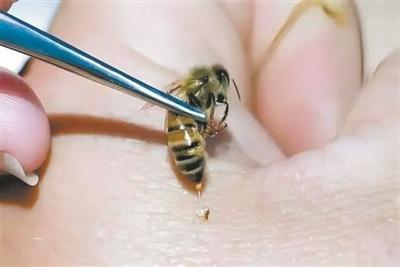 蜂针疗法传承千年，入选非遗名录，你了解吗？  第3张