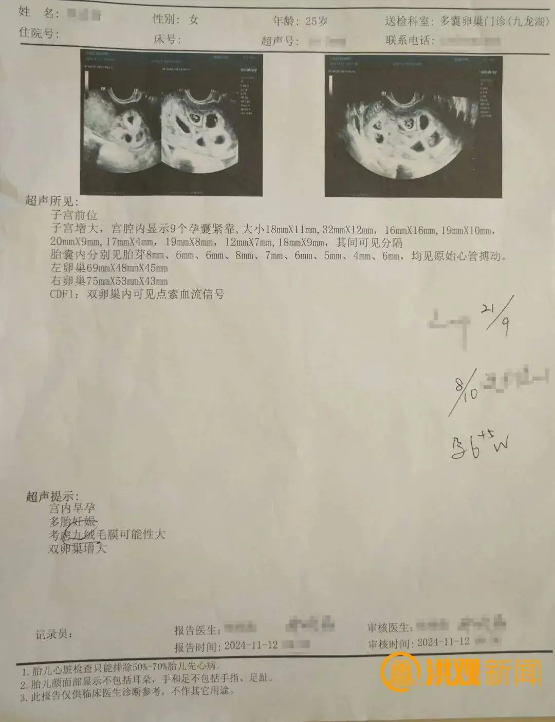 25 岁女子怀不上孕，打一针后竟怀上 9 胞胎，医生都惊了  第2张