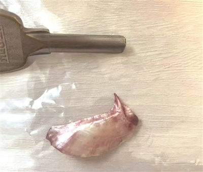 惊！46岁男子吃红烧鱼竟险些丧命，一根鱼刺引发的生死危机