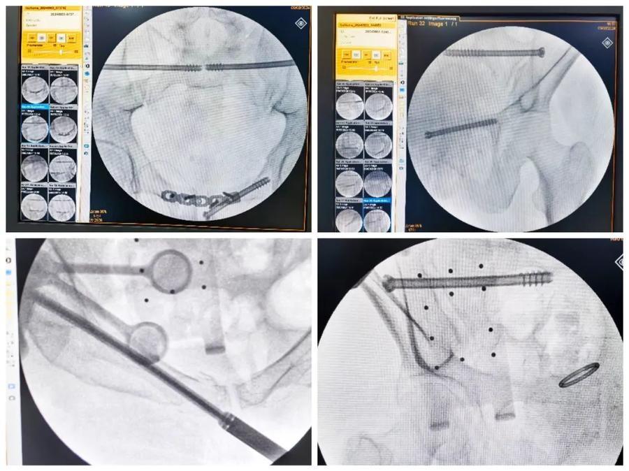 十余例骨盆骨折微创手术成功！机器人辅助，精准又安全  第3张