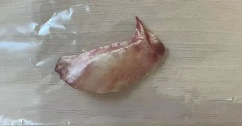 一块鱼刺差点夺命！46岁男子吞饭催吐险丧命，医生揭秘致命真相