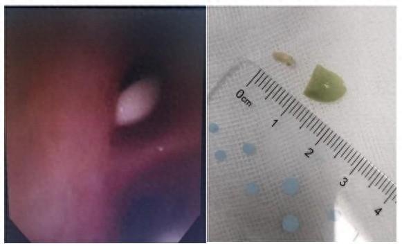 2 岁女童因吃饭哭闹险窒息，小小毛豆米为何成夺命凶手？  第1张