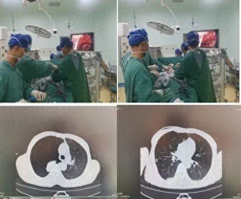 平度市第三人民医院成功实施胸腔镜肺大泡切除术，患者转危为安  第1张